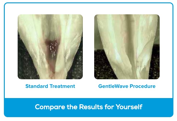 Gentlewave-comparison Gentlewave-comparison